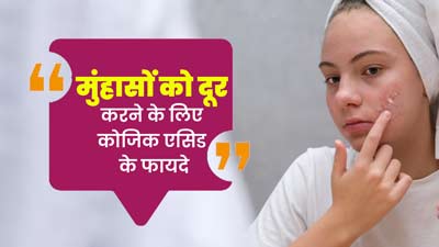 मुंहासों को दूर कर सकता है कोजिक एसिड, आप भी कर सकते हैं इस्तेमाल