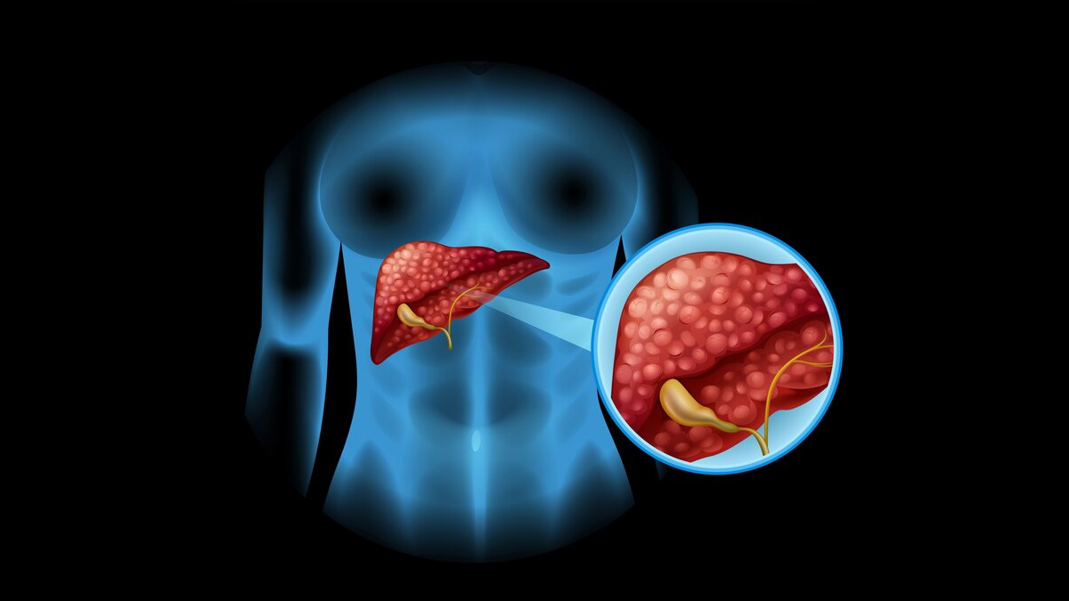 Why Are People Getting Affected From Bladder Cancer? Know The Prevention Tips