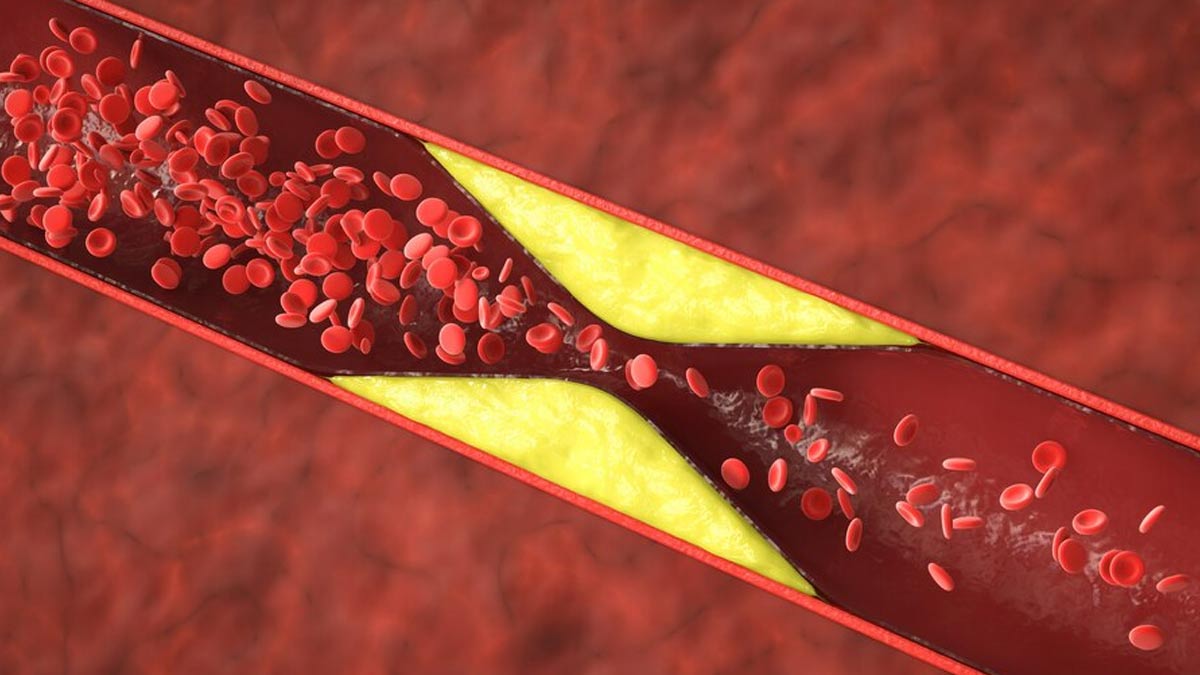 Dealing With High Cholesterol And Inflammation? Try These DIY Anti-Inflammatory Meals