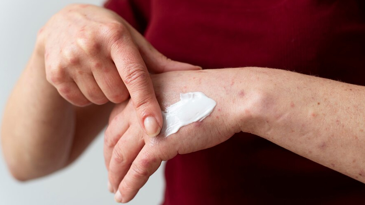 symptoms of weeping eczema in hindi 