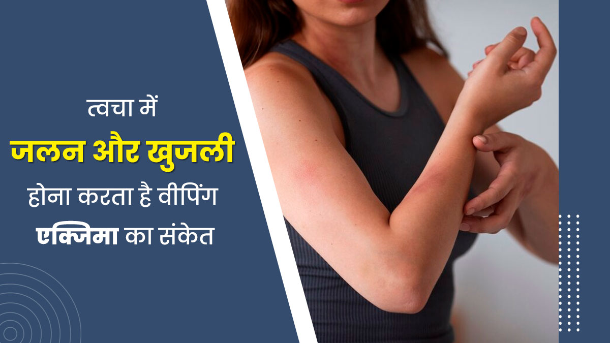 वीपिंग एक्जिमा (मवाद से भरे छाले) की वजह से त्वचा पर हो सकती है जलन और खुजली, जानें इसके अन्य लक्षण 