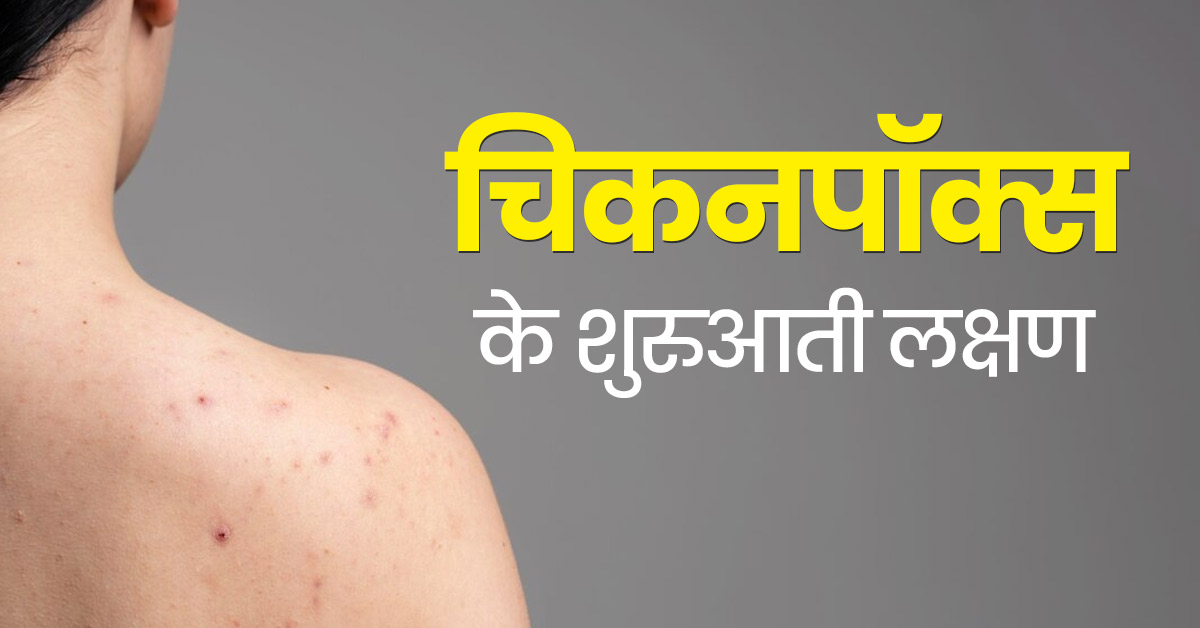 शरीर में दिख रहे ये संकेत हो सकते हैं चिकनपॉक्स के लक्षण, जानें बचाव