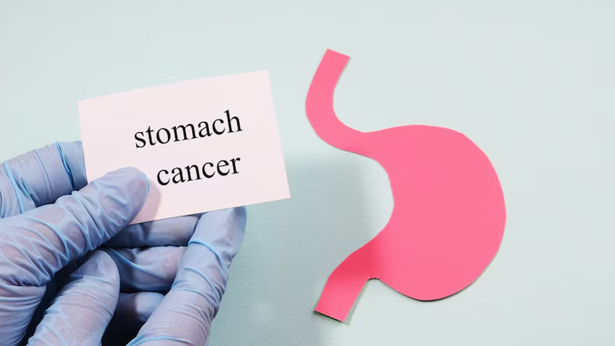 पेट के कैंसर के लक्षण: वे विभिन्न चरणों में कैसे आगे बढ़ते हैं