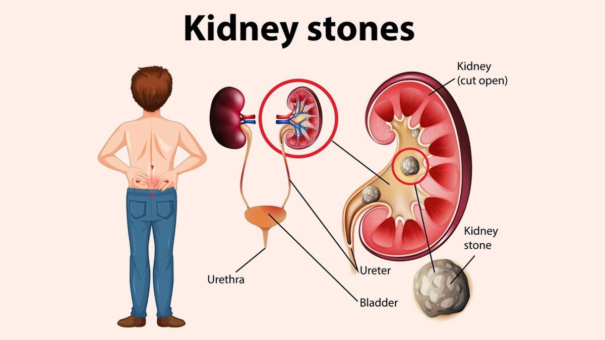 kidney stone