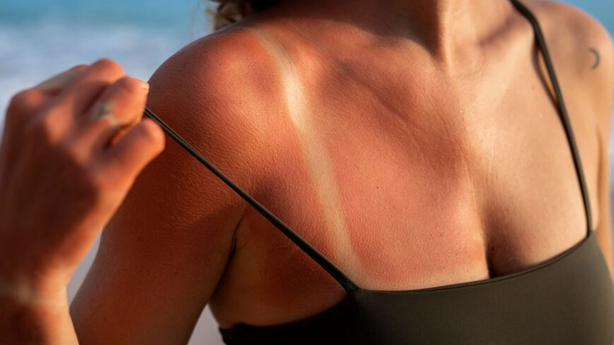Sunburn During Summer: How To Naturally Take Care Of It?