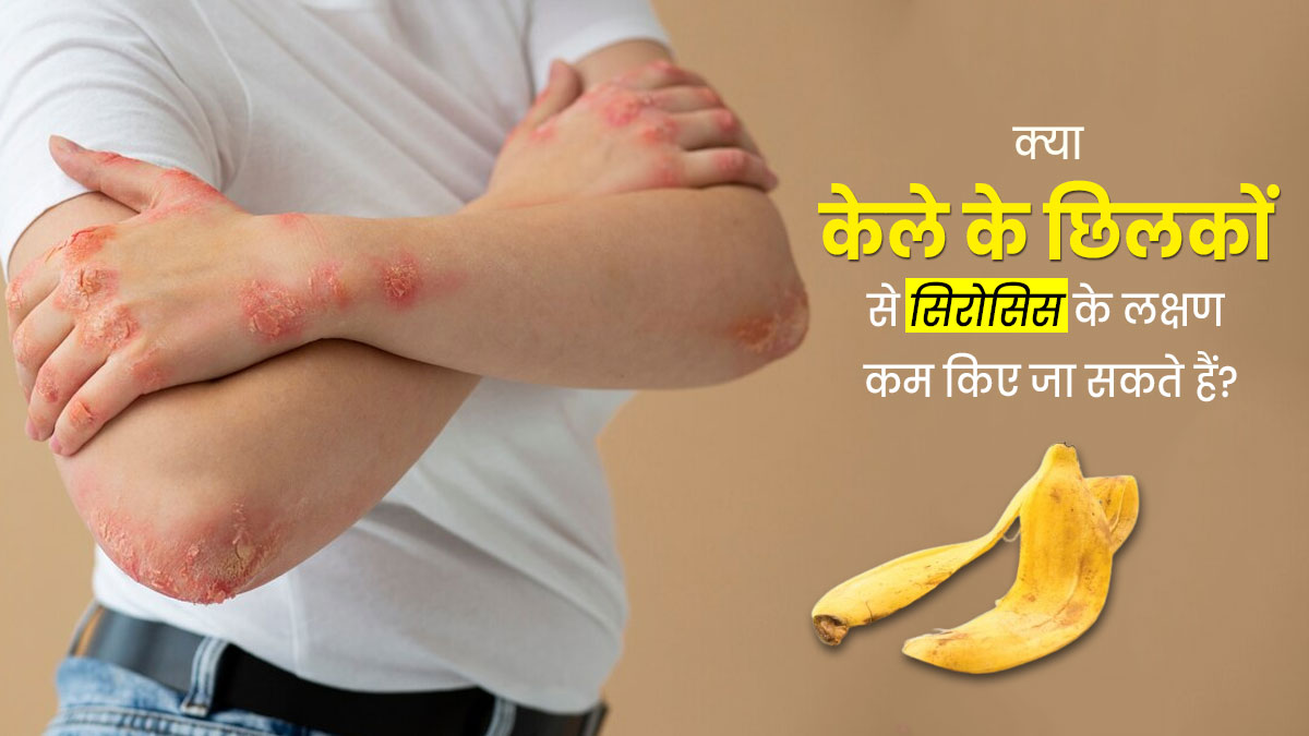 क्या केले के छिलकों से सिरोसिस के लक्षणों को दूर किया जा सकता है? एक्सपर्ट से जानें