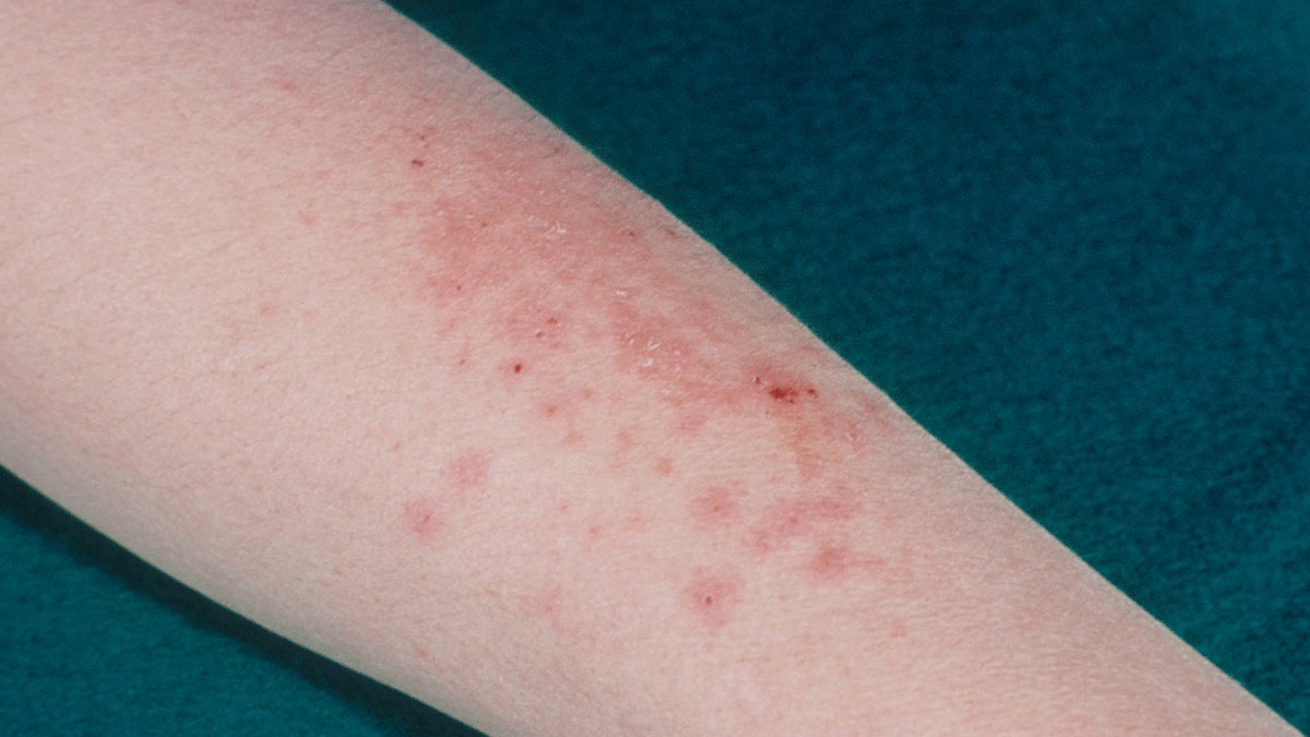 अमेरिका में मिला Sexually Transmitted Fungal Infection का पहला मामला, जानें इसके लक्षण और कारण 
