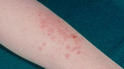 अमेरिका में मिला Sexually Transmitted Fungal Infection का पहला मामला, जानें इसके लक्षण और कारण 