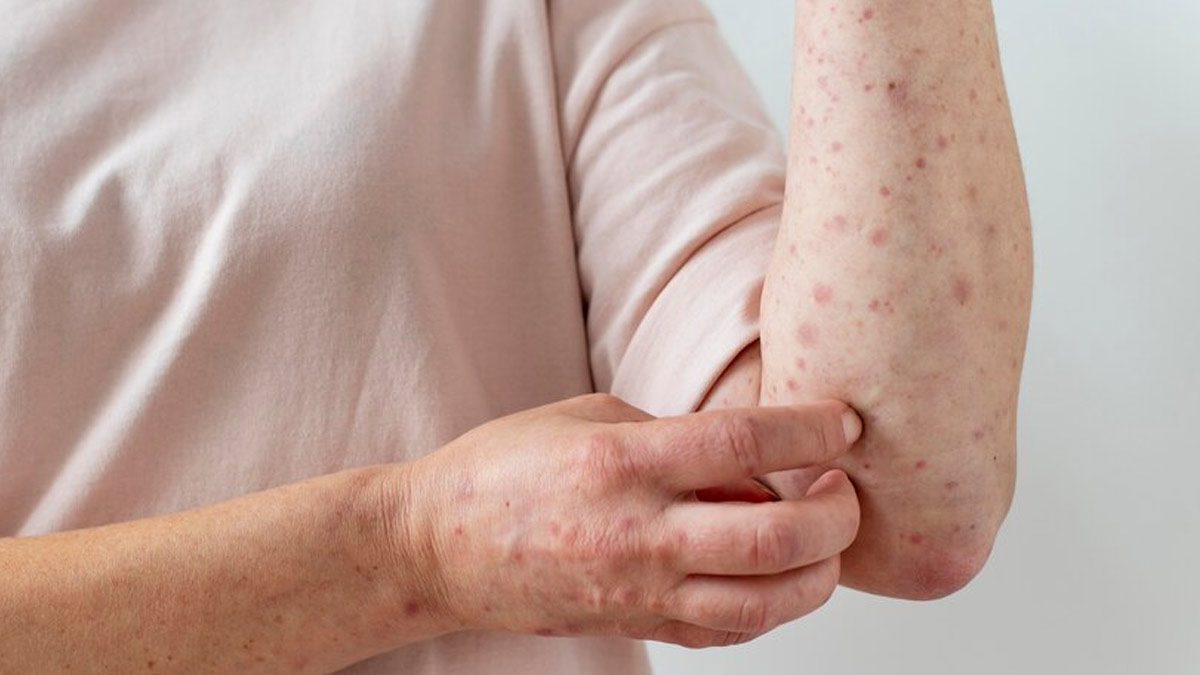 Eating Too Much Salt Can Raise Chances Of Eczema: Study