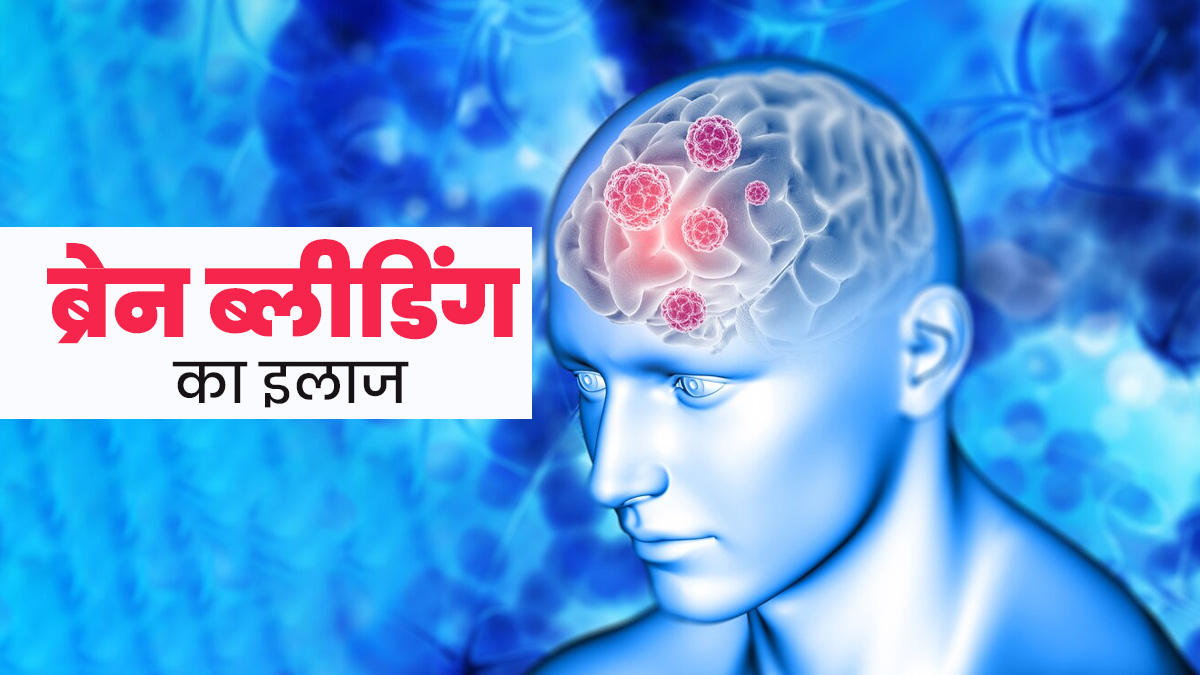 Brain Bleeding: ब्रेन ब्लीडिंग का इलाज कैसे किया जाता है? डॉक्टर से जानें