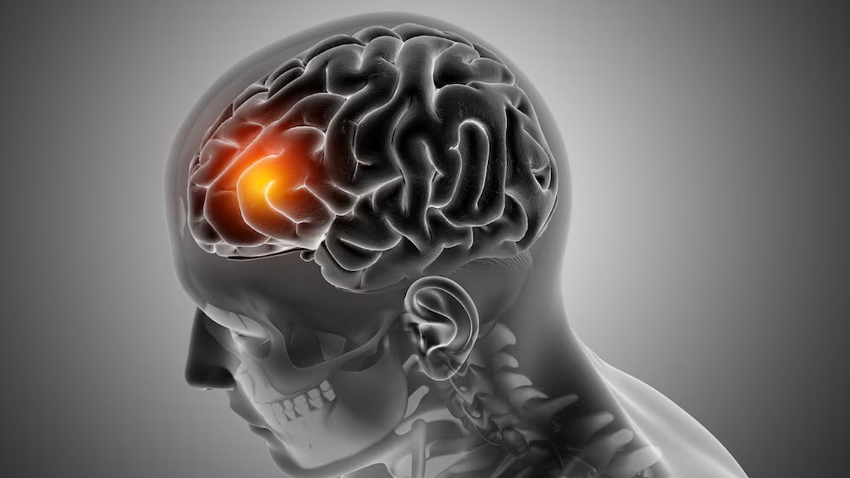 Bend Your Body, Strengthen Your Health: Yoga Asanas to Reduce Stroke Risk