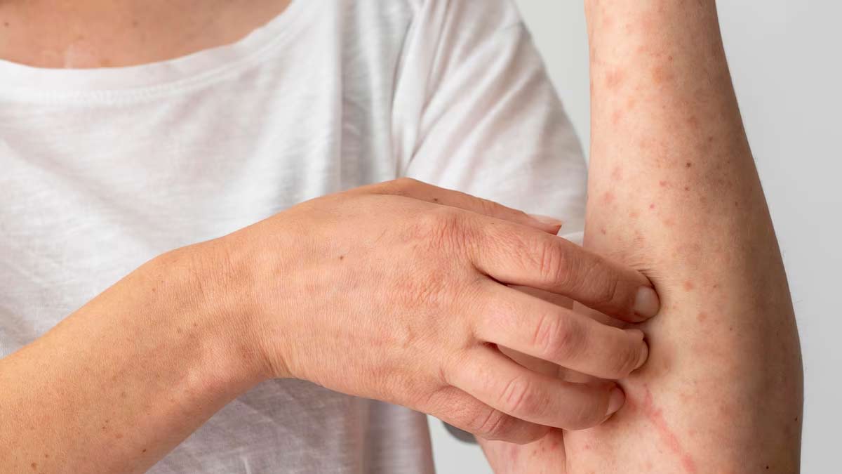 weeping eczema prevention tips 