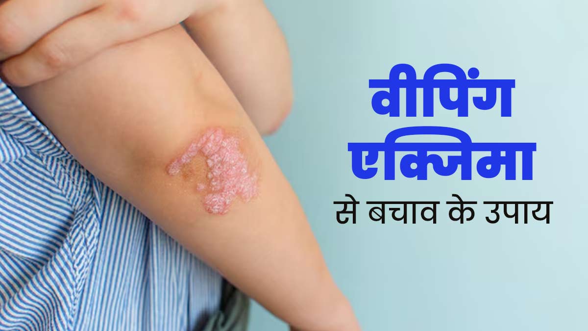 वीपिंग एक्जिमा (मवाद से भरे छाले) से बचने के लिए अपनाएं ये 5 उपाय