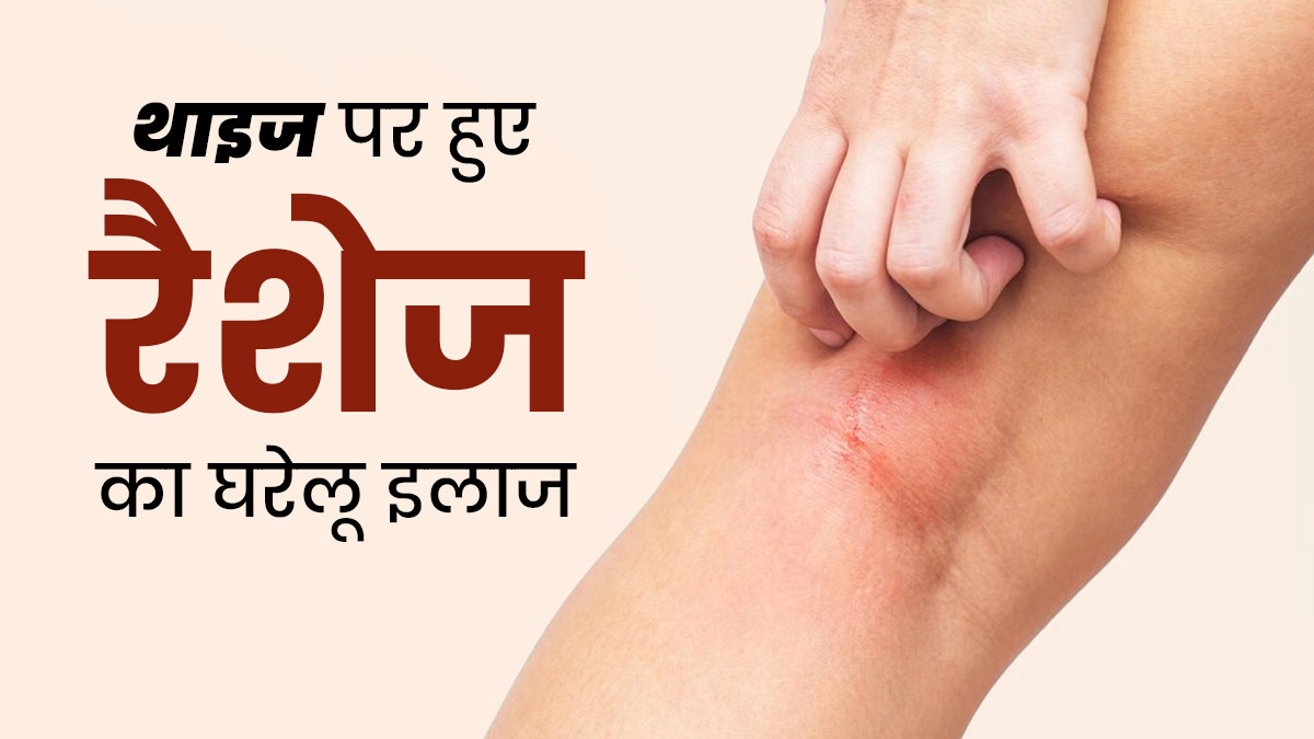 गर्म‍ियों में पसीने से जांघ में हो जाते हैं रैशेज, तो राहत के ल‍िए अपनाएं ये 5 घरेलू उपाय  