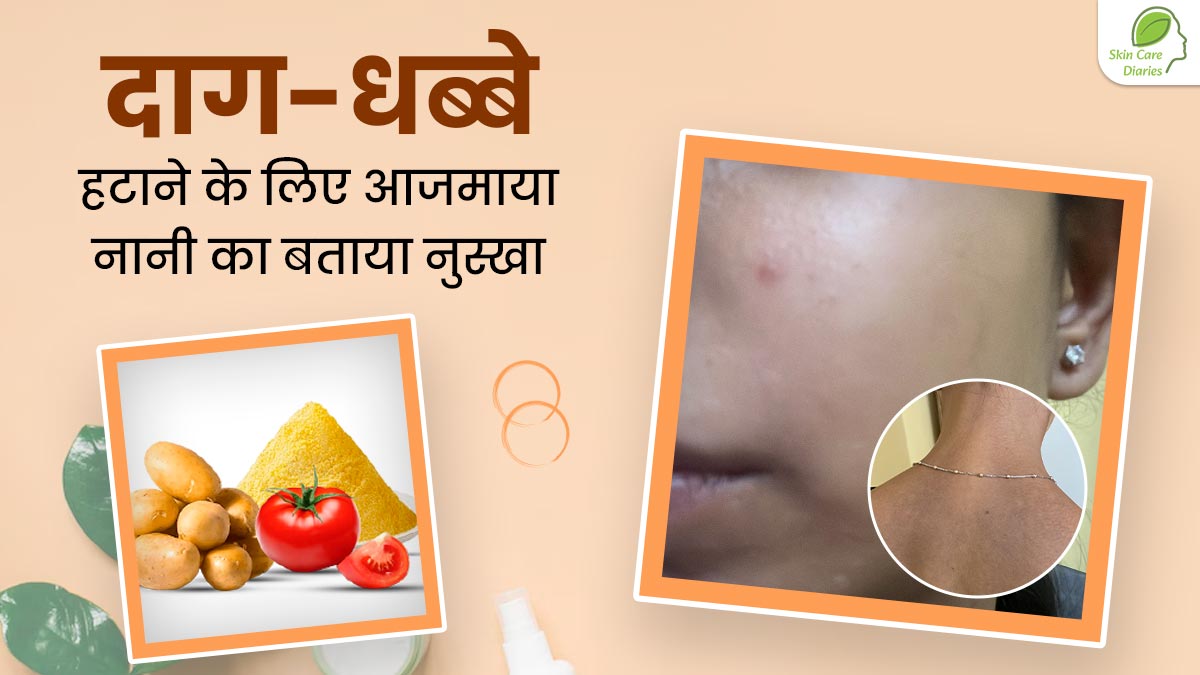Skin Care Diaries: दाग-धब्बे मिटाने के लिए श्रेया ने आजमाया नानी का बताया यह खास नुस्खा, आप भी करें ट्राई
