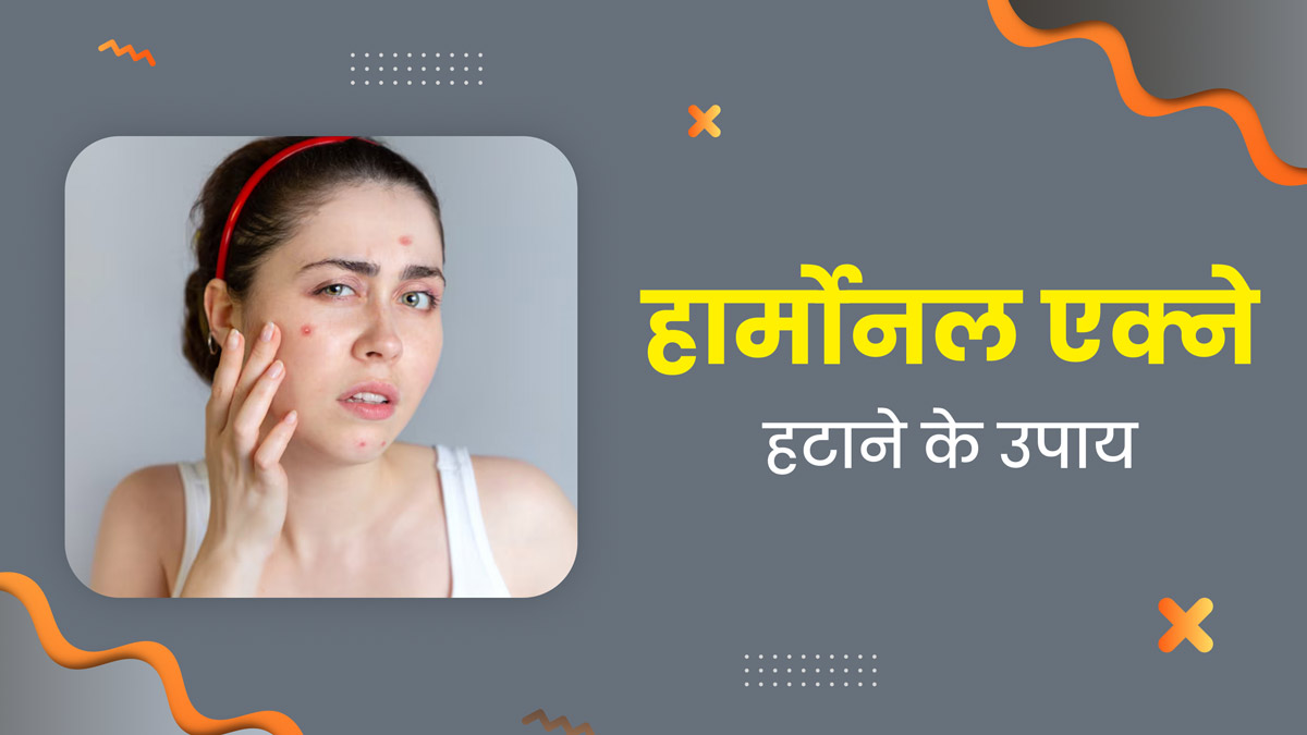 हार्मोनल एक्ने को हटाने के लिए फॉलो करें ये 3 स्टेप, स्किन बनेगी खूबसूरत