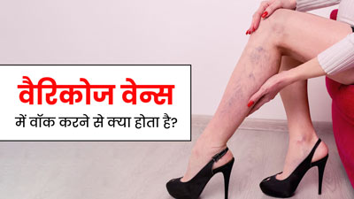 क्या वॉक करने से वैरिकोज वेन्स का जोखिम कम होता है? जानें नसों की सेहत के लिए क्यों जरूरी है चलना 