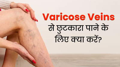 वैरिकोज वेन्स होने पर लाइफस्टाइल में करें ये 5 बदलाव, मिल सकती है राहत