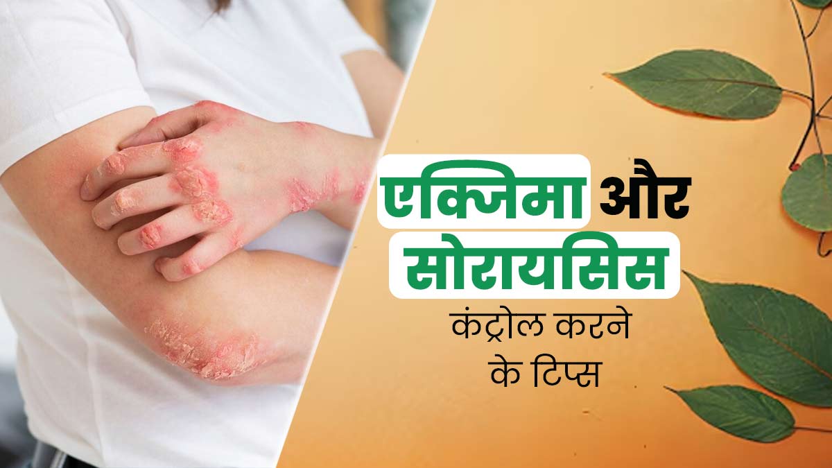 एक्जिमा और सोरायसिस से पीड़ित लोग अपनाएं ये 5 टिप्स, लक्षणों को मैनेज करने में मिलेगी मदद