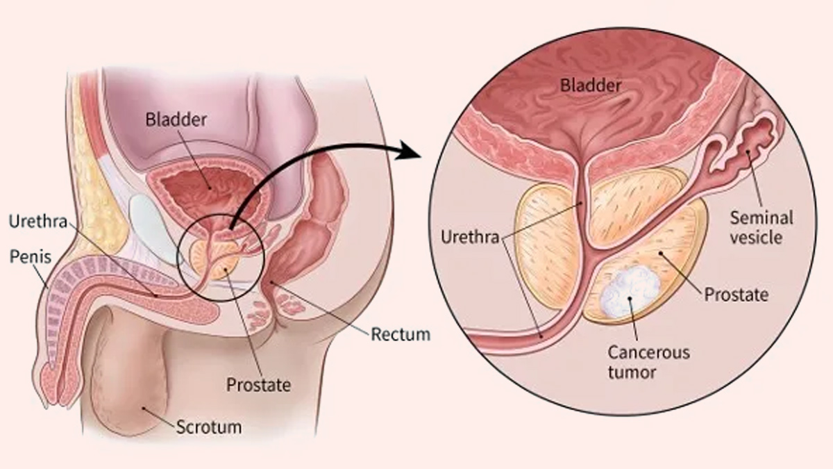 Prostate Cancer