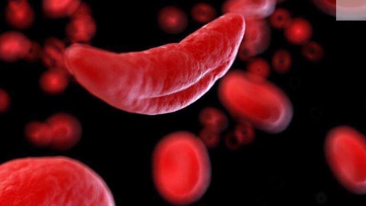 World Sickle Cell Anemia Day 2024: Theme, Importance, Why It's Observed