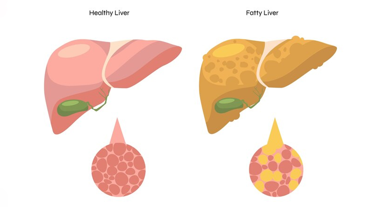Can Non Alcoholic Fatty Liver Be Reversed In Hindi