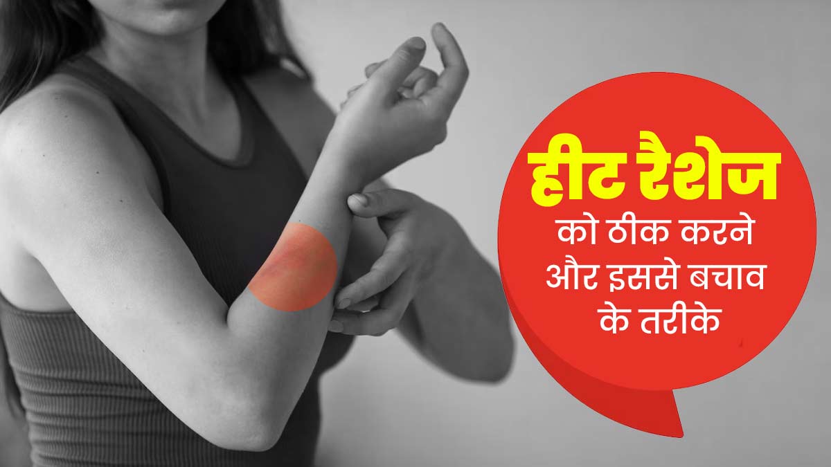 रैशेज ठीक करने के लिए अपनाएं ये 4 नेचुरल उपाय, जलन और खुजली से मिलेगी राहत