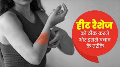 रैशेज ठीक करने के लिए अपनाएं ये 4 नेचुरल उपाय, जलन और खुजली से मिलेगी राहत
