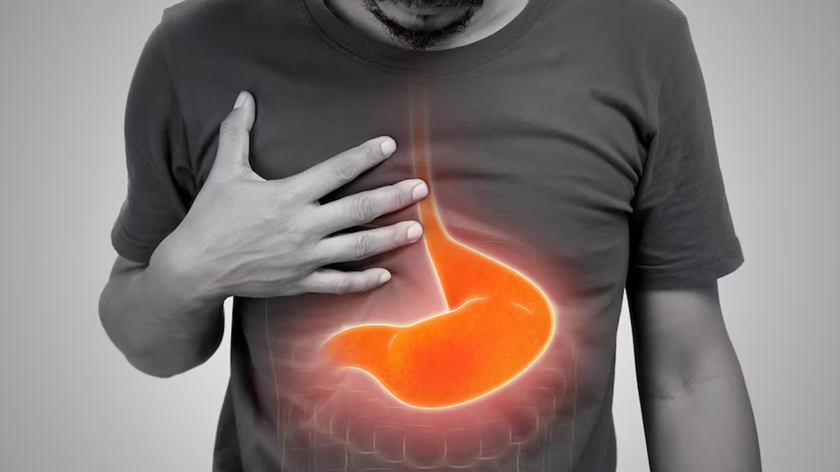 Heartburn Acid Reflux and GERD