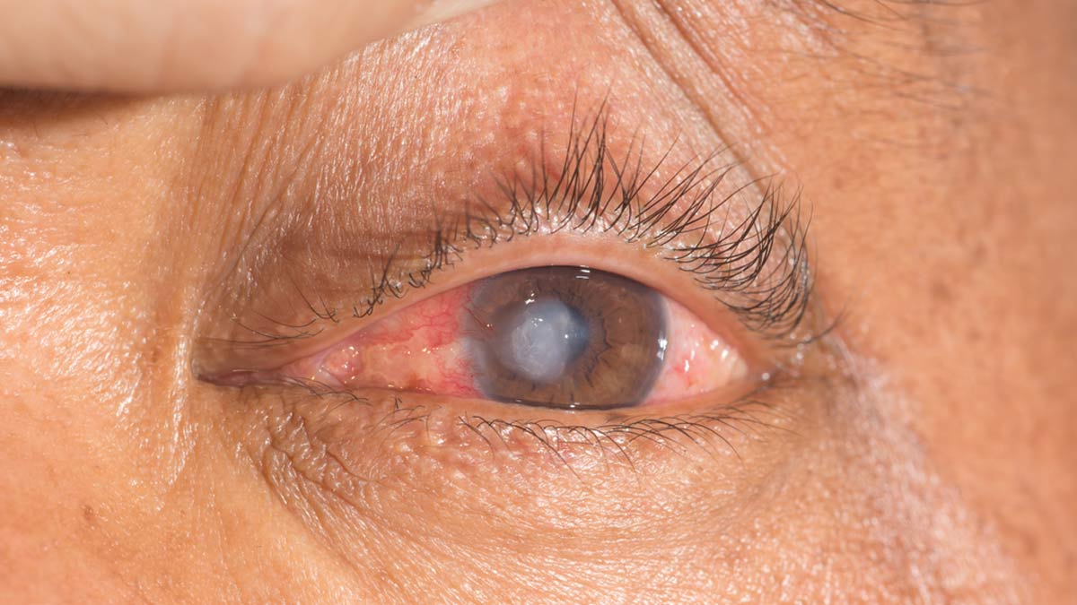 Essential Eye Care: Follow These 7 Tips To Prevent Corneal Ulcers