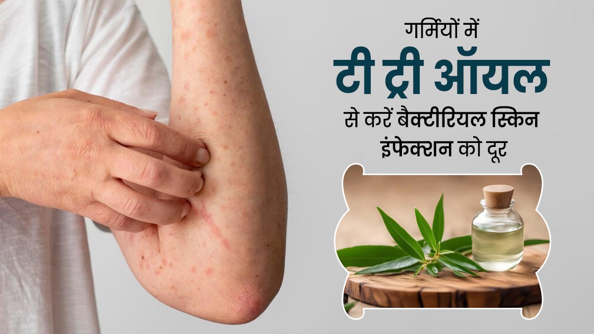 गर्मियों में टी ट्री ऑयल से करें बैक्टीरियल स्किन इंफेक्शन का इलाज, जानें इसके फायदे  