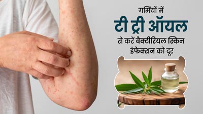 गर्मियों में टी ट्री ऑयल से करें बैक्टीरियल स्किन इंफेक्शन का इलाज, जानें इसके फायदे  