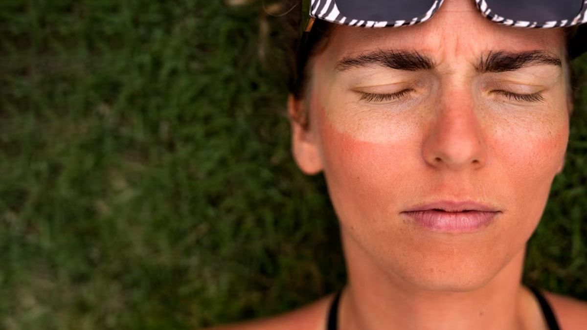 Lavender Oil For Sunburn Relief: Here's How It Can Soothe The Pain
