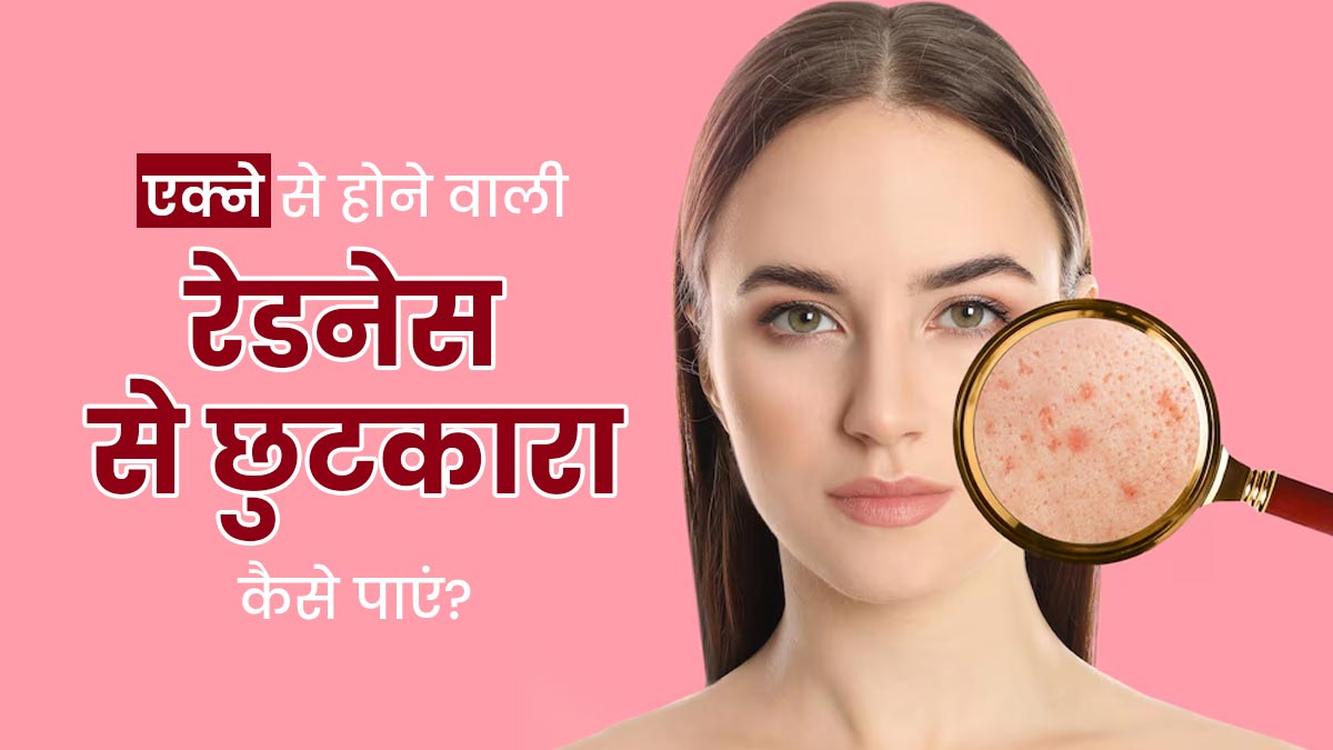 एक्ने से होने वाली रेडनेस और निशान को दूर करने के लिए अपनाएं ये 5 घरेलू उपाय, बेदाग रहेगी त्वचा 
