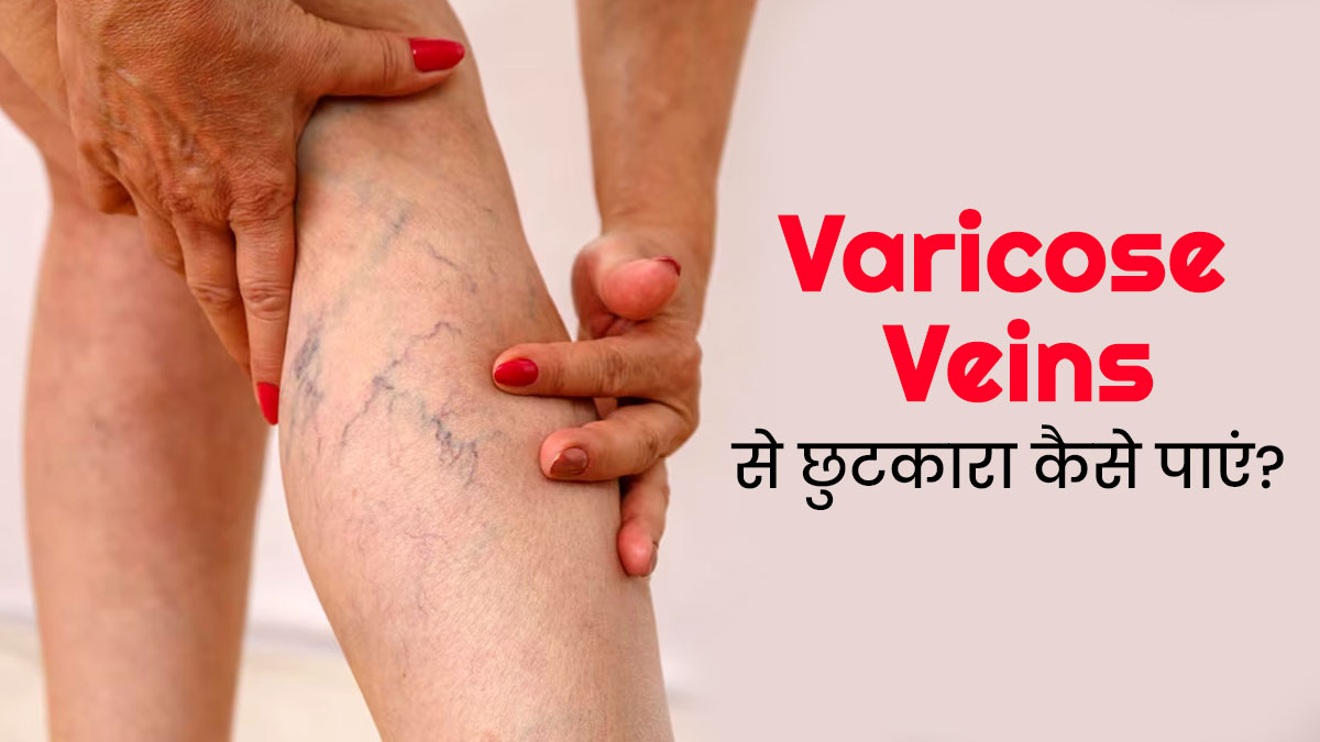 वैरिकोज वेन्स (उभरी नीली नसों) से छुटकारा पाने के लिए अपनाएं ये 5 तरीके, नसों की सेहत में दिखेगा सुधार