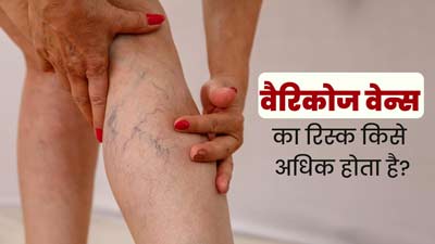इन 5 तरह के लोगों को रहता है वैरिकोज वेन्स (उभरी हुई नसें) होने का अधिक जोखिम, न बरतें लापरवाही