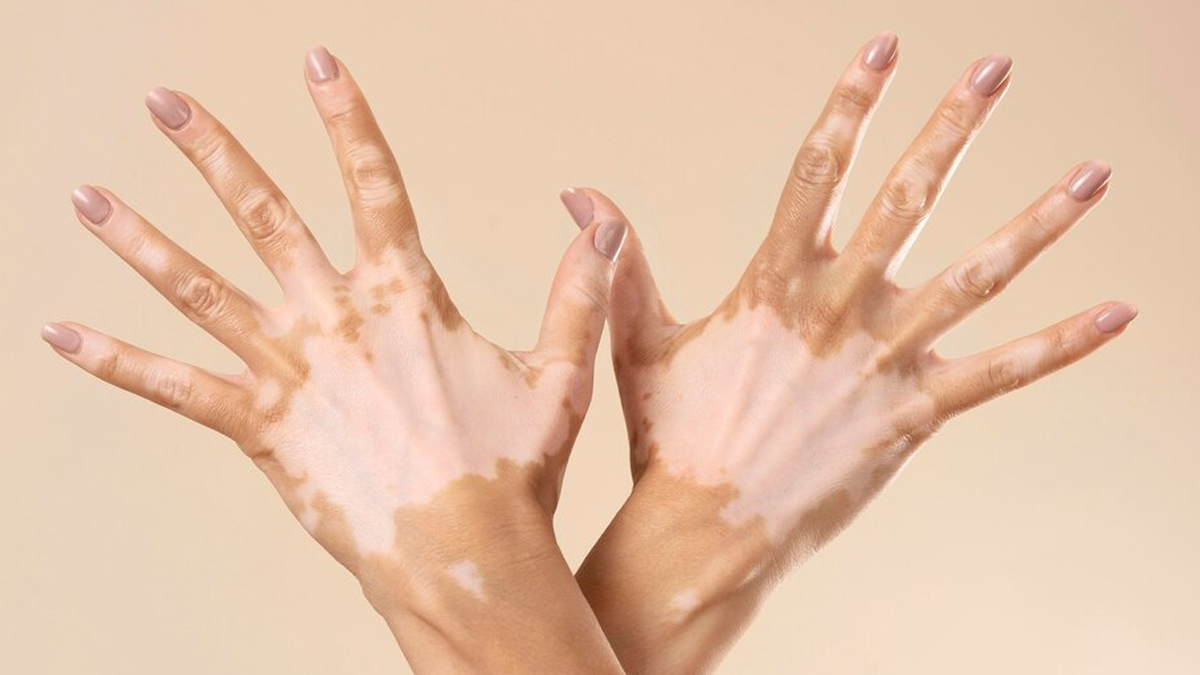 vitiligo