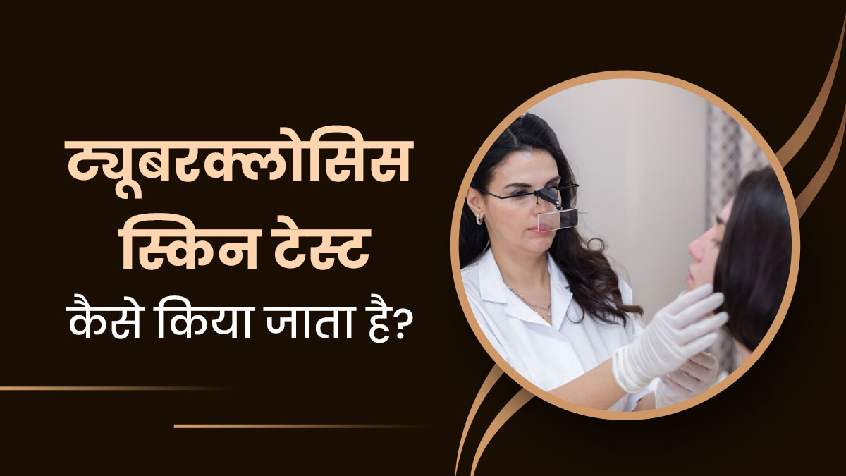 ट्यूबरक्लोसिस स्किन टेस्ट कैसे किया जाता है? जानें डॉक्टर से 