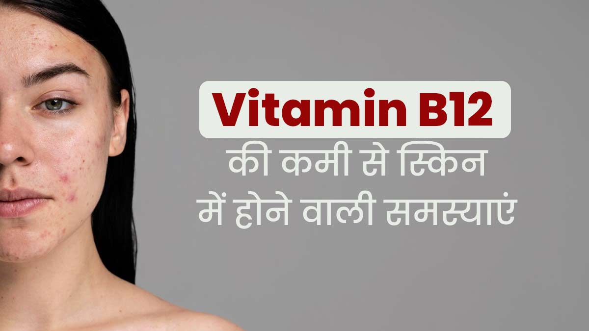 विटामिन बी 12 की कमी से भी हो सकती है स्किन हाइपरपिग्मेंटेशन की समस्या, जानें बचाव के उपाय 