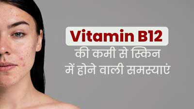 विटामिन बी 12 की कमी से भी हो सकती है स्किन हाइपरपिग्मेंटेशन की समस्या, जानें बचाव के उपाय 