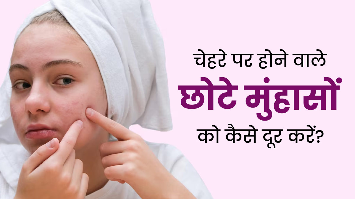 चेहरे पर होने वाले छोटे मुंहासों को दूर करने के लिए अपनाएं ये 5 टिप्स