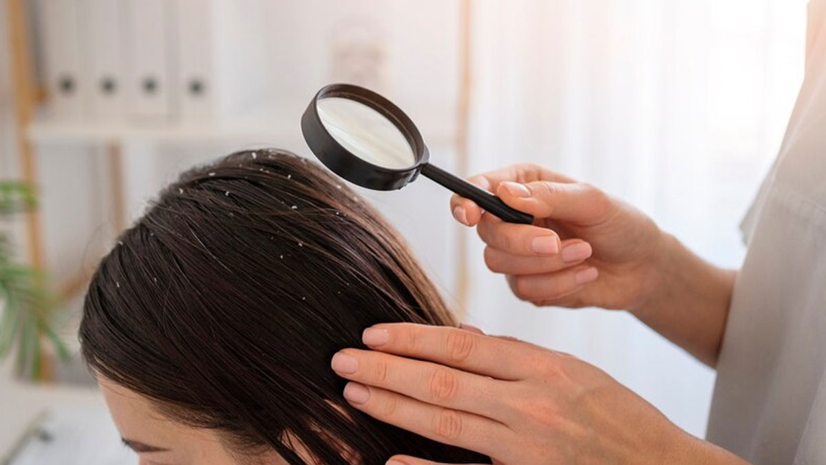 Scalp Psoriasis Vs Dandruff: Expert Lists Key Differences You Should 