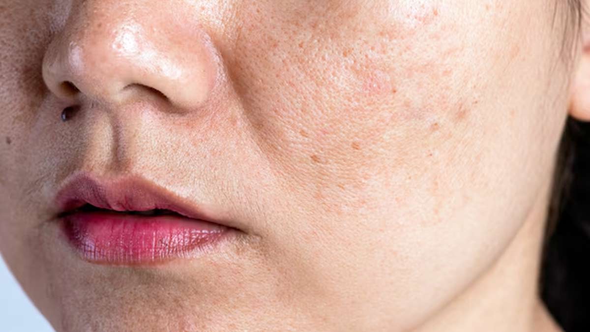 ayurvedic remedies for pigmentation 