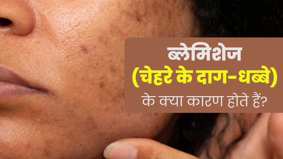 ब्लेमिशेज (चेहरे के दाग-धब्बे) होने के हो सकते हैं ये 5 कारण, जानें एक्सपर्ट से 