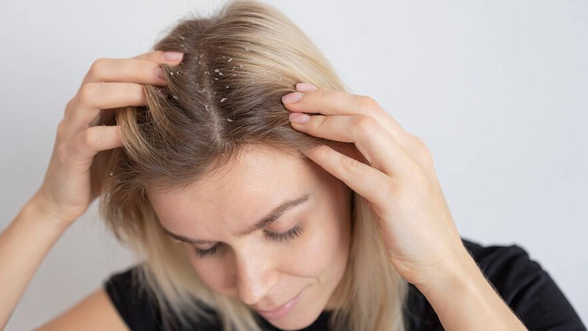 Scalp Psoriasis Vs Dandruff Expert Lists Key Differences You Should Know Onlymyhealth 8584