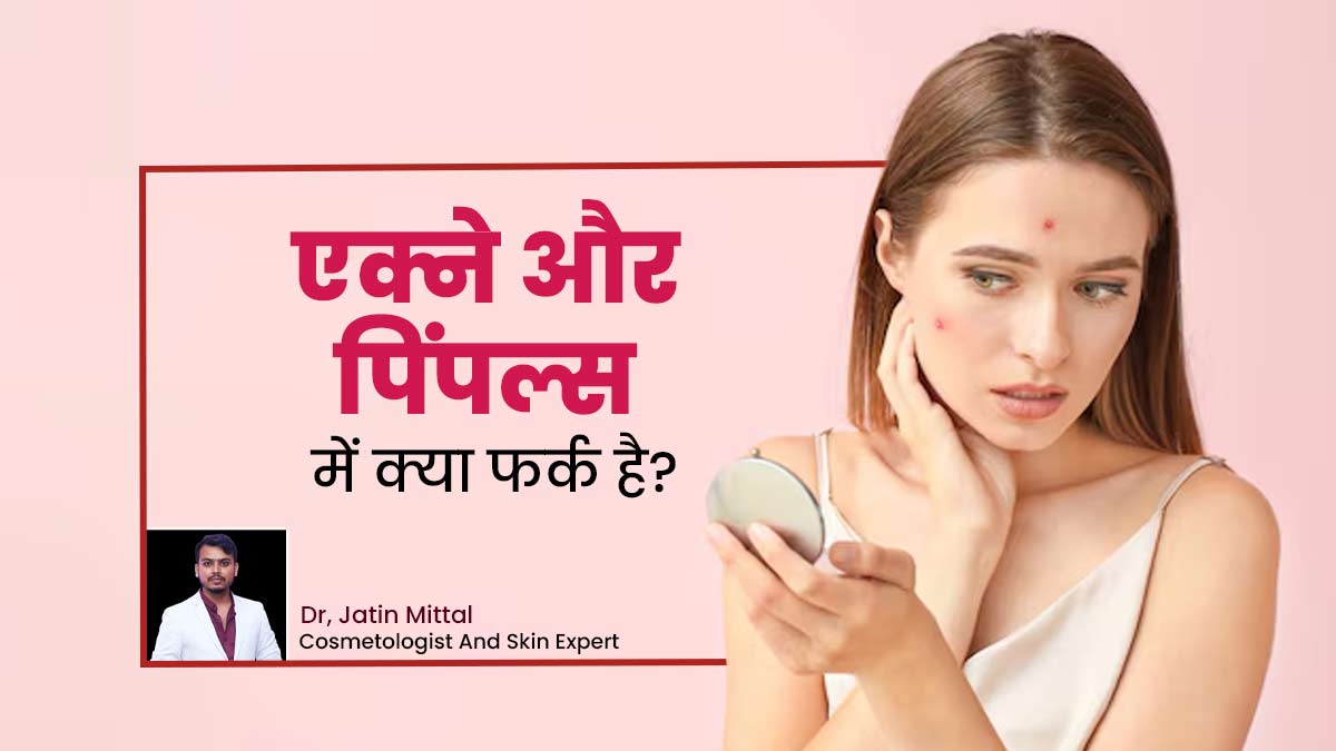 एक्ने और पिंपल्स में अंतर कैसे पहचानें? जानें दोनों समस्याओं के लक्षण और बचाव के उपाय