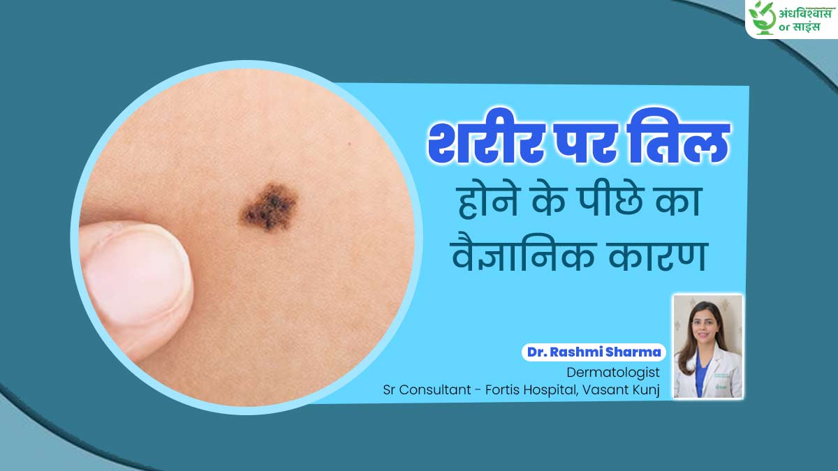 अंधविश्वास या साइंस: क्या वाकई हथेली पर तिल होना अमीरी का संकेत होता है? डॉक्टर से जानें वैज्ञानिक तथ्य