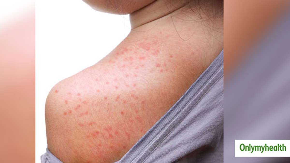 Multani mitti benefits for prickly heat