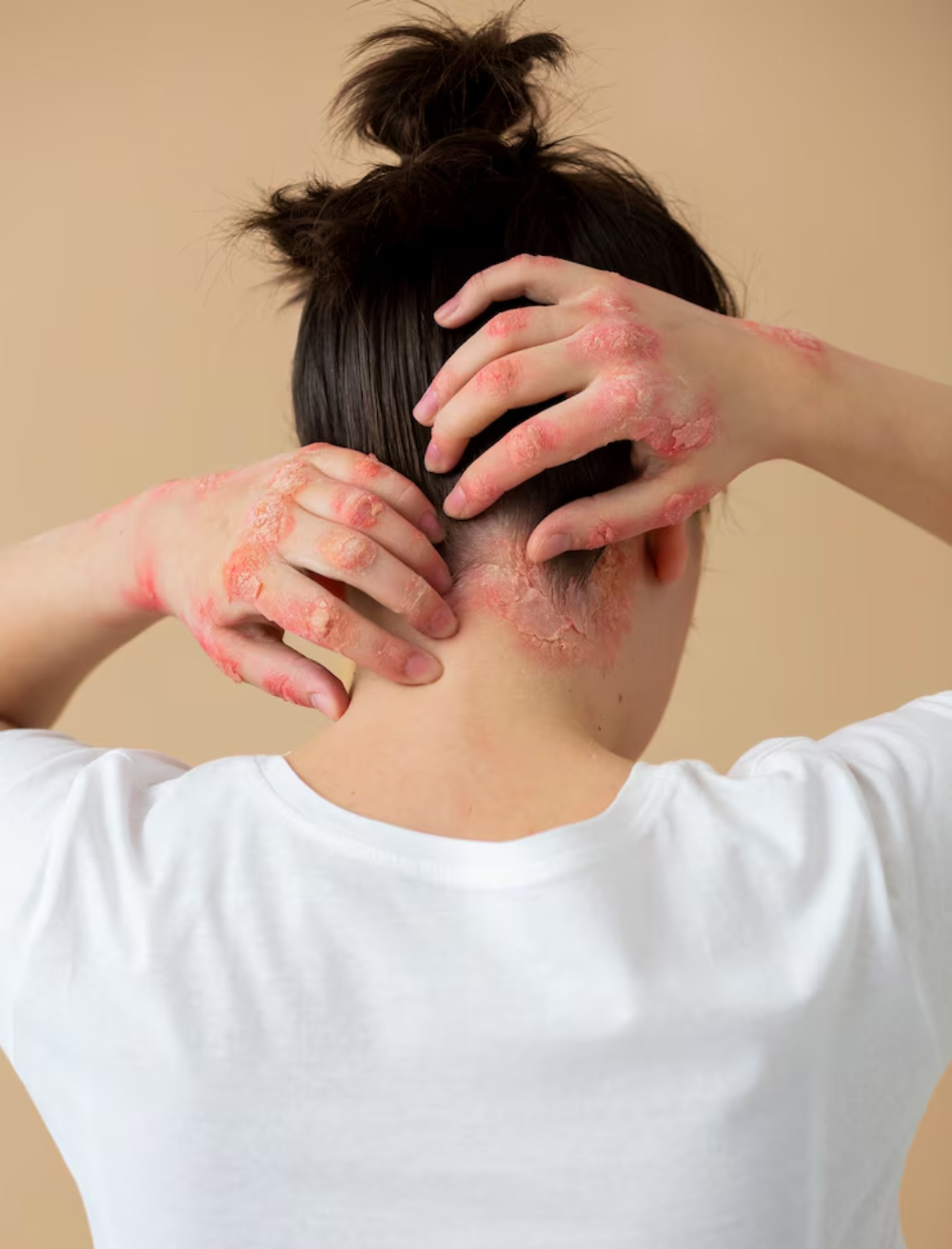 scalp-psoriasis