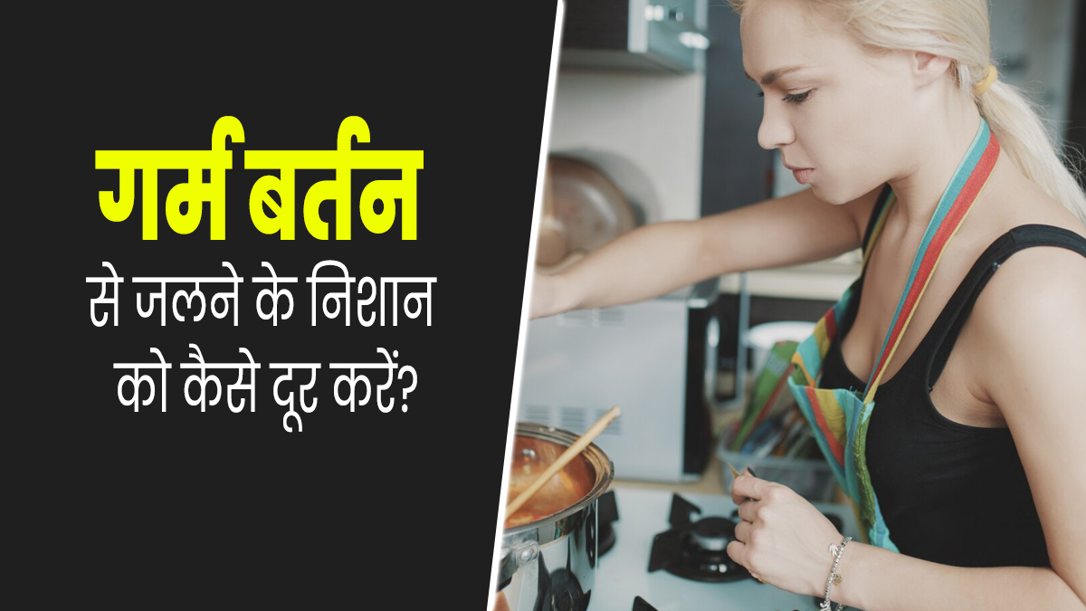 किचन में काम करते समय जल गई है त्वचा, तो राहत पाने के लिए अपनाएं ये 5 घरेलू उपाय